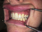 Fig 2. Slightly raised spongiotic lesion superior to the interdental papilla between teeth Nos. 11 and 12.