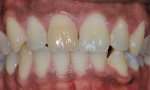 Figure 1  A single dark tooth will bleach well, but may not lighten as much as the other teeth if all are bleached at the same time.