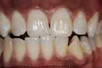 Figure 3  For this patient, bleaching the single dark tooth matched the other non-bleached teeth well, but the single tooth did not get any lighter that the other teeth, so the other teeth were not bleached.