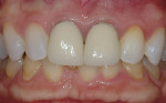 Figure 5  Use of 10% carbamide peroxide internally in a “walking bleach style” with the use of external bleaching using 10% carbamide peroxide in a non-scalloped, no-reservoir tray produces a more esthetic result.