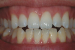 Figure 8  Continuation of bleaching will allow the background of the tooth to lighten such that the white spots are less noticeable. Upon termination, white areas tend to return to their original color.