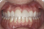 Figure 13  A 40-year-old patient presented with an avulsed left central incisor that had been bonded to the adjacent teeth.