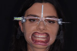 Fig 3. A retracted photograph of the patient wearing the glasses was used to measure each tooth and form a treatment plan to improve her smile.