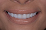 Fig 17. Post-treatment close-up smile, left lateral, and right lateral, photographs of the final prepless lithium disilicate veneers.