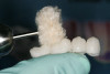 Figure 7  Bone allograft (FDBA) was placed to obturate the extraction sites.