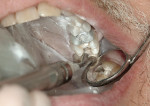 Figure 3  Powdering the preparation and adjacent teeth in the remainder of the quadrant.
