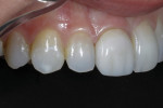 Fig 2. Preoperative retracted left view demonstrates the high chroma on the cervical third of the natural teeth and moderate translucency on the incisal third.