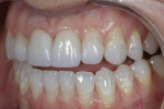Fig 12. Postoperative retracted view of the six anterior teeth. The final restorations match the gradient of adjacent teeth and the white spot lesions have been removed using a resin infiltration technique.