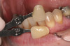 Figure 22  Surgical template, supported by the four remaining teeth and soft tissues. Sequential computer-guided implant placement was used to further stabilize subsequent implant insertions.