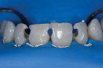 Fig 9 and Fig 10. Intraoperative view showing severe palatal structural compromise, especially in areas of marginal ridges and cinguli, frontal view (Fig 9) and occlusal view (Fig 10).
