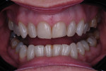 Fig 14 and Fig 15. One-week reassessment post-rehydration of the anterior teeth showing excellent optical integration, retracted view (Fig 14) and smile view (Fig 15).