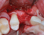 Operative view of the site of tooth No. 6 following 4 months of healing after extraction and ridge preservation. Note the horizontal deficiency.