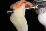 The custom healing abutment was placed using Sohn’s poncho technique to create a biologic tissue seal.