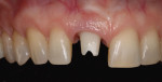 A scan of the screw-retained temporary crown was sent to the laboratory for the fabrication of a custom abutment, which was placed and scanned intraorally.