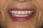 Fig 12. Esthetics, phonetics, VDO, and occlusion were verified. The patient was highly pleased with the final result.