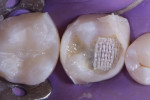 Placement of stress-reduced direct composite restorations with polyethylene fiber. After the walls and cervical areas were completed on tooth No. 19, a polyethylene fiber material (Ribbond® Ultra, Ribbond) was lightly placed on top of a layer of microhybrid composite (CLEARFIL™ AP-X [A2], Kurarary Noritake) prior to being wetted with adhesive and imbedded into composite resin.