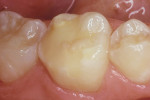 Figure 6  Vitremer repair 9 years after treatment.