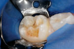 Figure 10  Large enamel hypoplasia/caries lesion of a primary second molar.
