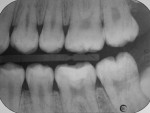 Fig 7. Final assessment post-treatment bitewing radiograph (December 2020). A pulp vitality test indicated that the pulp of tooth No. 19 was vital.