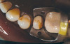 Figure 16  Anterior, lateral right, and left view of the maxillary prosthesis teeth try-in.