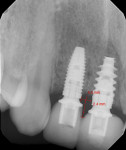 Fig 2. Initial radiograph of implants Nos. 7 and 8 with final restoration when patient presented. The distance between the two implants was 2.4 mm, and the distance between inter-implant crestal bone to the contact point was 4.5 mm.