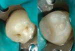 Possible caries on mandibular bicuspid, pretreatment (left). After enamelplasty, restoration was done with Beautifil Kids SA (right).