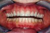 Figure 17  Postoperative photograph of teeth Nos. 18 to 20 in a case with subgingival margins. Photograph courtesy of Yi-Yuan Chang.