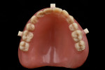 Fig 3. Existing denture with radiopaque markers on flanges.