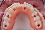 Fig 5. Occlusal view of 3D-printed provisional at try-in before surgery.