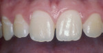 Figure 1  Patients before and after tray bleaching.