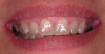 Figure 3  Patients before and after tray bleaching.