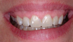 Figure 4  Patients before and after tray bleaching.